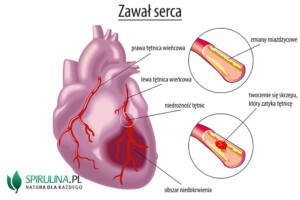 Zawał serca