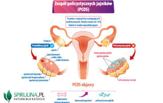 Zespół policystycznych jajników