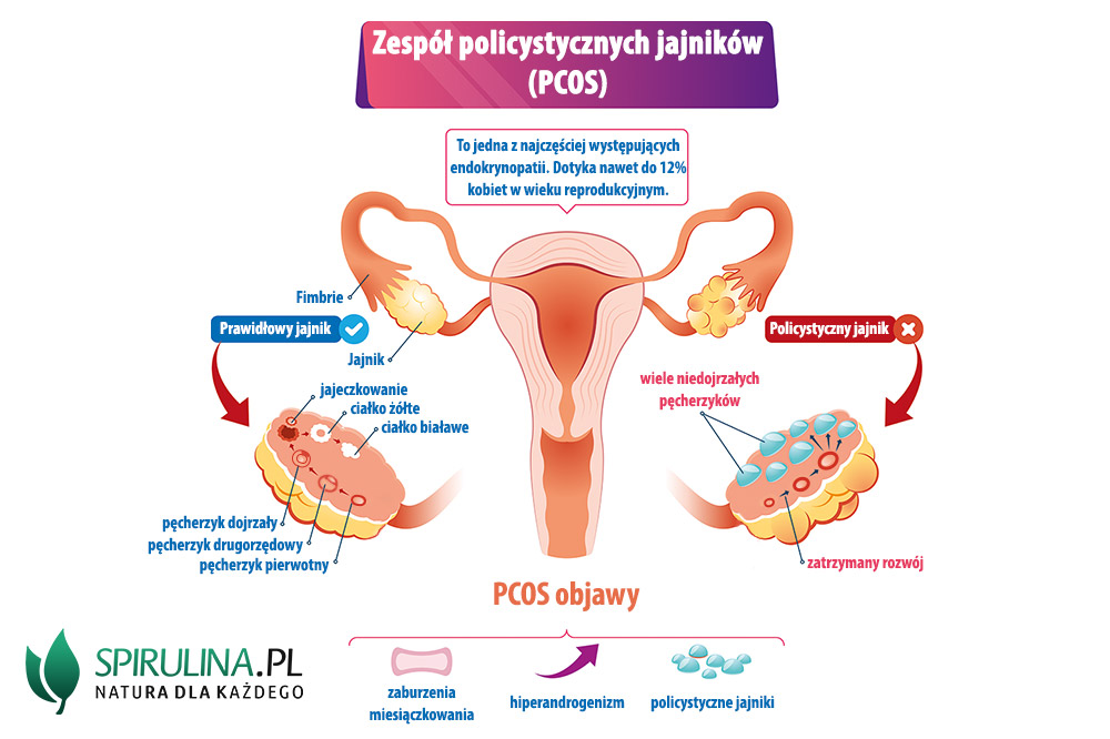 Zespół policystycznych jajników