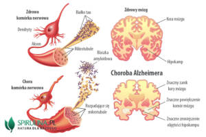 Choroba Alzheimera