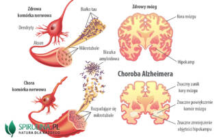 Choroba Alzheimera