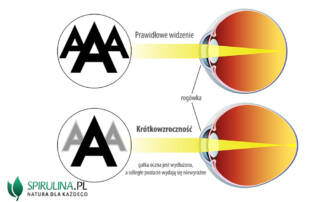 Krótkowzroczność