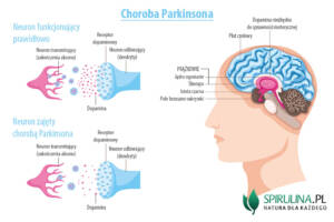 Choroba Parkinsona