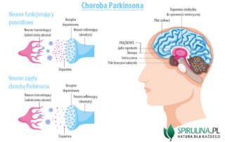 Choroba Parkinsona