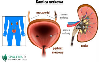 Kolka nerkowa (kamica nerkowa)