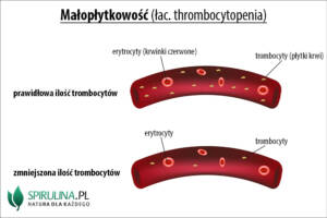 Małopłytkowość (łac. thrombocytopenia)