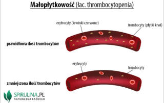 Małopłytkowość (łac. thrombocytopenia)