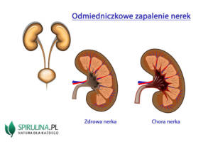 Odmiedniczkowe zapalenie nerek