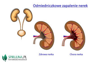 Odmiedniczkowe zapalenie nerek