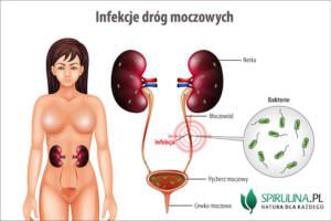 Infekcje dróg moczowych