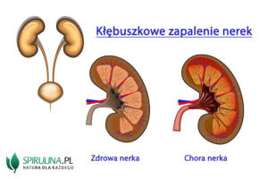 Kłębuszkowe zapalenie nerek