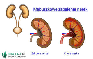 Kłębuszkowe zapalenie nerek