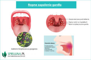 Ropne zapalenie gardła