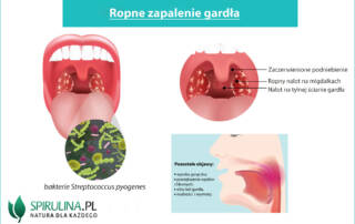 Ropne zapalenie gardła