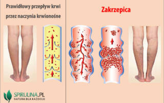 Zakrzepica