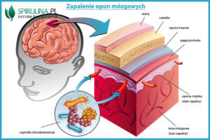 Zapalenie opon mózgowych