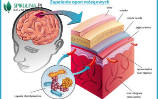 Zapalenie opon mózgowychh