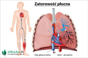 Zatorowość płucna