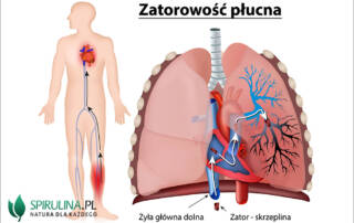 Zatorowość płucna