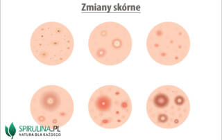 Zmiany trądzikowe