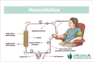 Hemodializa