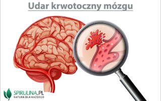 Udar krwotoczny