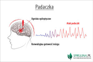 Padaczka