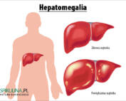 Hepatomegalia