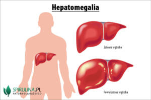 Hepatomegalia