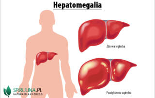 Hepatomegalia