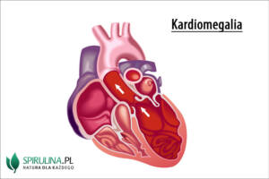 Kardiomegalia