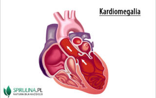 Kardiomegalia