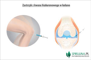 Zastrzyk z kwasu hialuronowego w kolano