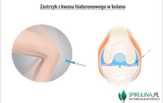 Zastrzyk z kwasu hialuronowego w kolano