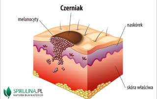 Czerniak