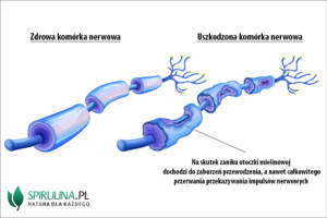 Neuropatia obwodowa