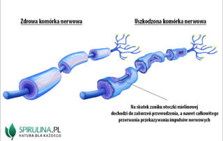 Neuropatia obwodowa