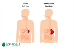 Powiększona śledziona