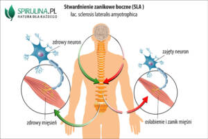 Stwardnienie zanikowe boczne (SLA)