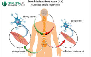 Stwardnienie zanikowe boczne (SLA)