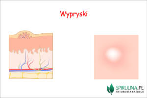 Wypryski na twarzy