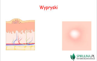 Wypryski na twarzy