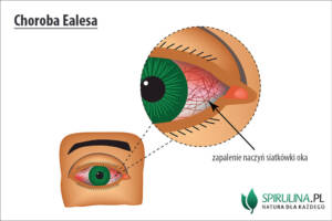 Choroba Ealesa