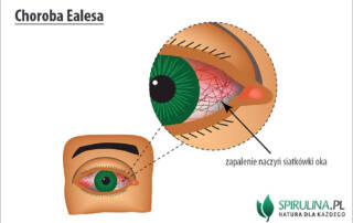 Choroba Ealesa