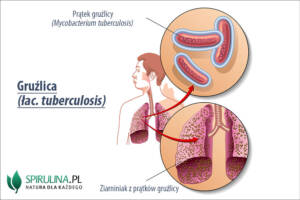 Gruźlica