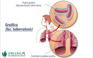 Gruźlica