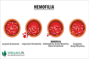 Hemofilia