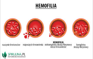 Hemofilia