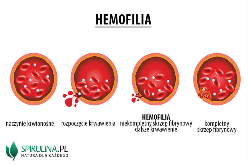 Hemofilia - algi Spirulina i Chlorella