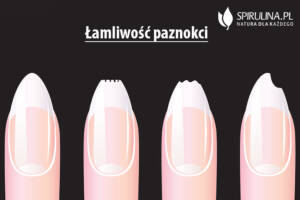 Łamliwość paznokci